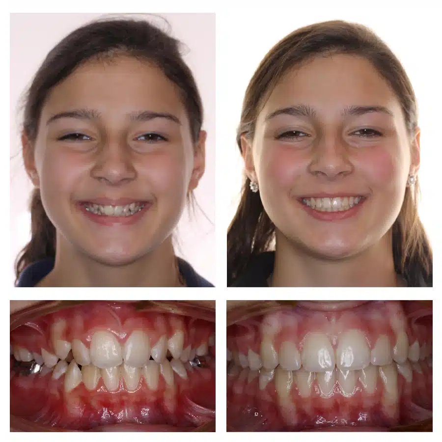 Grace Campbell Before and After